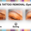 eyebrows2_removal_beforeafter transvid