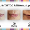 lips_removal_beforeafter transvid